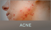 Acne Acne