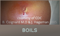 Boils Boils