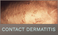 Contact Dermatitis Contact Dermatitis