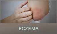 Eczema Eczema