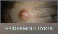Epidermoid Cysts Epidermoid Cysts