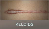 Keloids Keloids