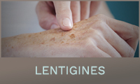 Lentigines Lentigines