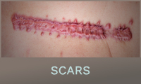 Scars Scars