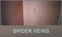 Spider Veins Spider Veins