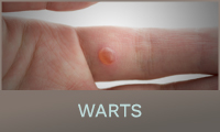 Warts Warts